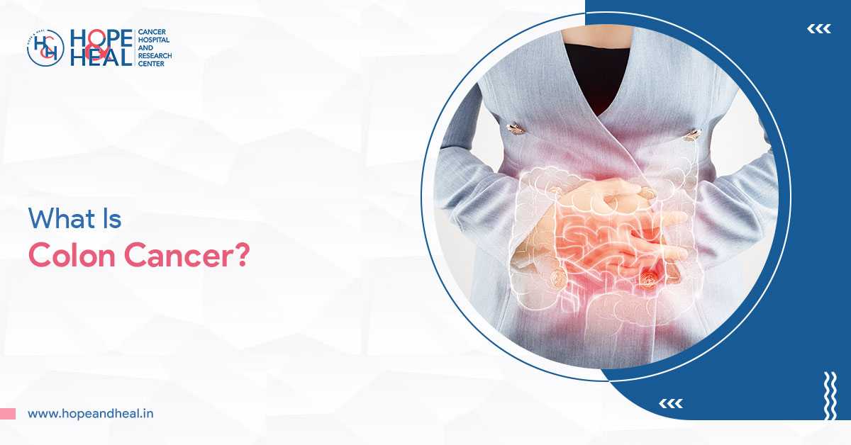 Understanding Colon Cancer – Symptoms & Prevention