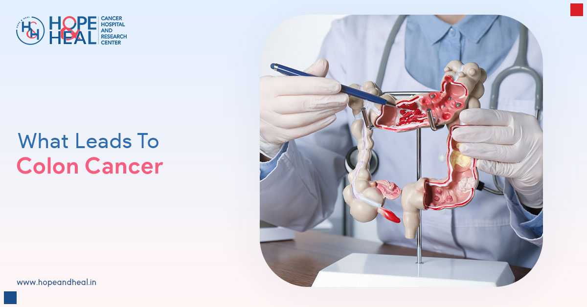 5 Risk Factors For Colon Cancer – Let’s Discuss