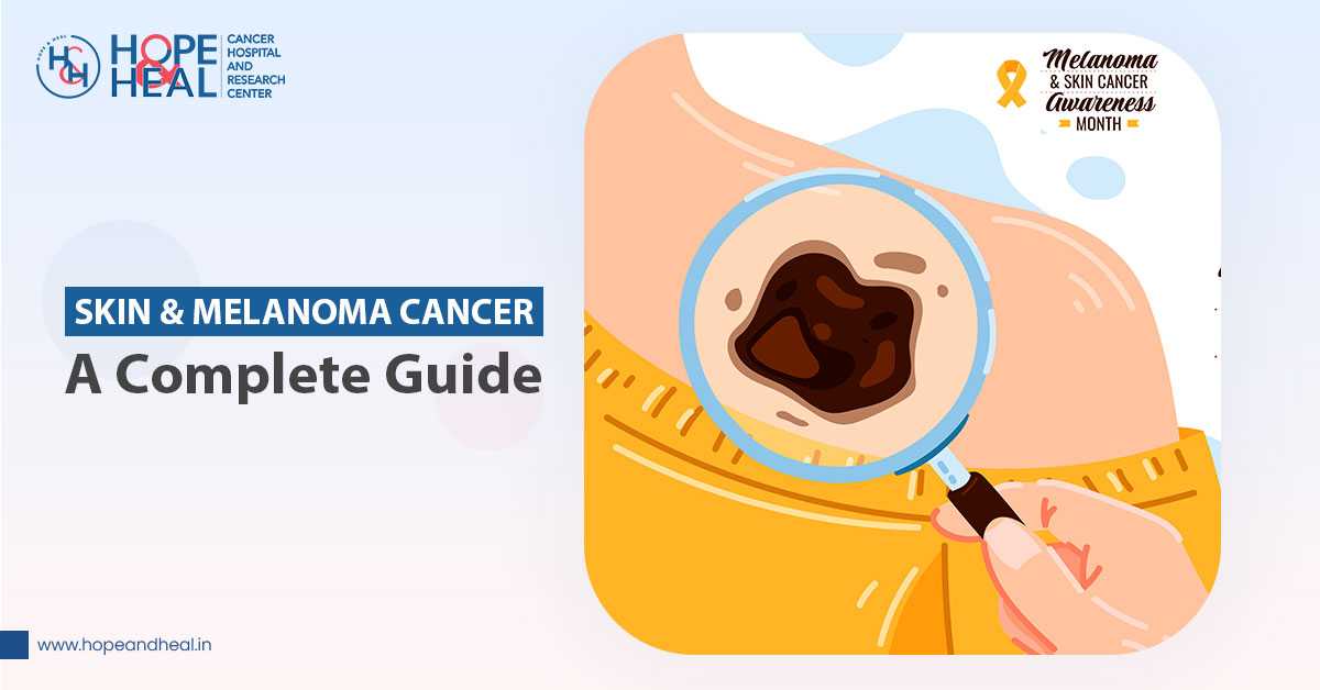 Skin & Melanoma Cancer: A Complete Guide